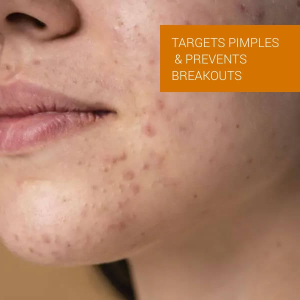 Anti Pimple Cream 75 Gm
